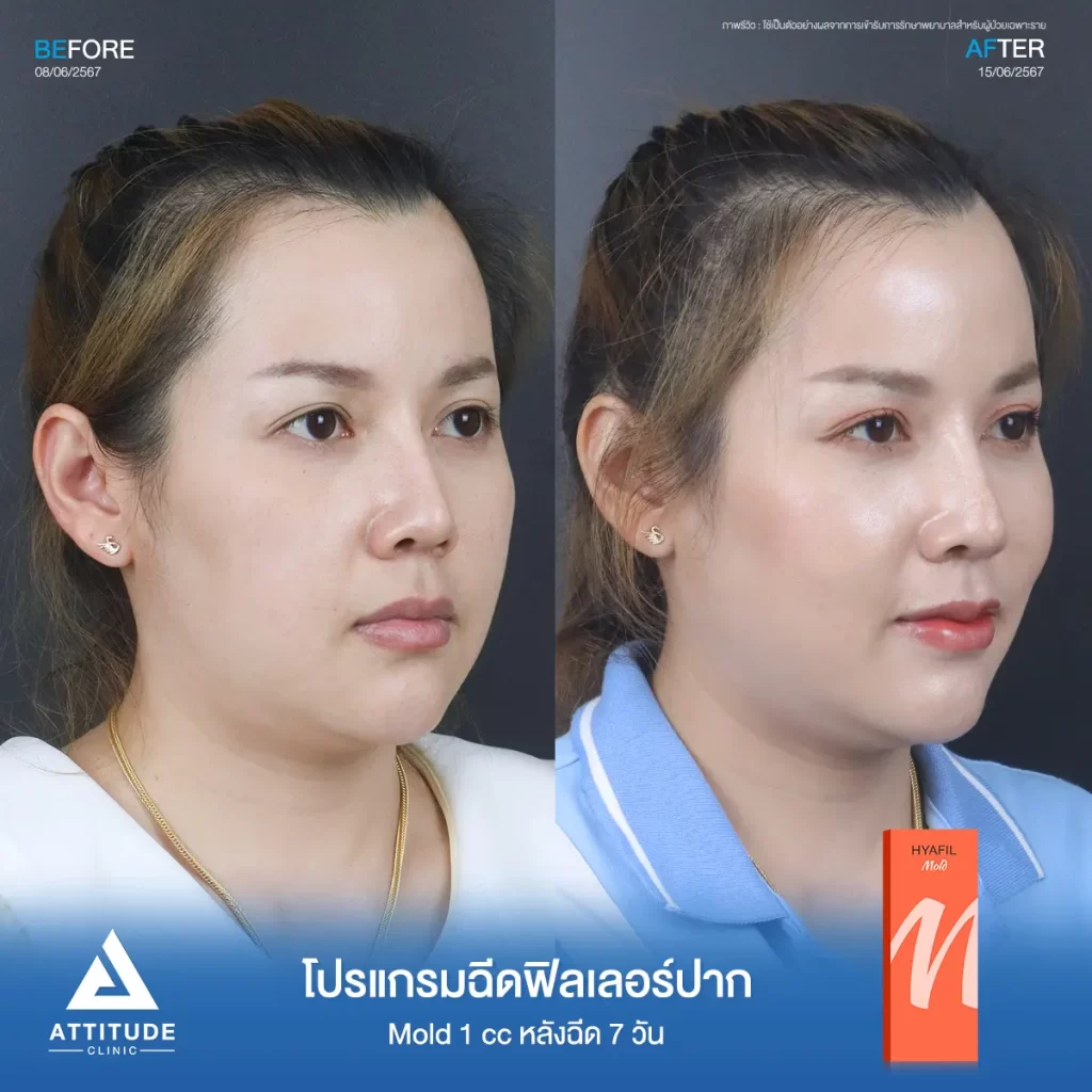 รีวิวโปรแกรมฉีดฟิลเลอร์ปากคุณมิกซ์ รุ่น M จำนวน 1 cc หลังฉีด 7 วัน เติมเต็มให้อวบอิ่ม เป็นทรงสวยตามที่ต้องการ มุมปากยก ได้รูป ริมฝีปากเรียบเนียน ดูเป็นธรรมชาติที่ Attitude Clinic