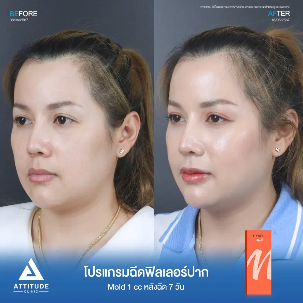 รีวิวโปรแกรมฉีดฟิลเลอร์ปากคุณมิกซ์ รุ่น M จำนวน 1 cc หลังฉีด 7 วัน เติมเต็มให้อวบอิ่ม เป็นทรงสวยตามที่ต้องการ มุมปากยก ได้รูป ริมฝีปากเรียบเนียน ดูเป็นธรรมชาติที่ Attitude Clinic