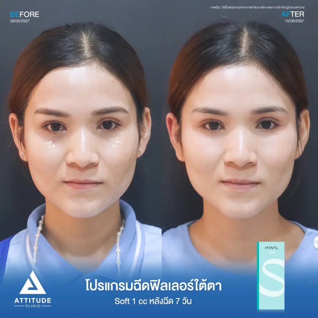 รีวิวโปรแกรมฉีดฟิลเลอร์ใต้ตาคุณน้ำตาล รุ่น S จำนวน 1 cc หลังฉีด 7 วัน เติมเต็มร่องใต้ตาให้อิ่มฟู แก้ใต้ตาหมองคล้ำทำกลับมาสดใส ลดริ้วรอยเล็กๆ ให้ตาตาดูเรียบเนียนที่ Attitude Clinic