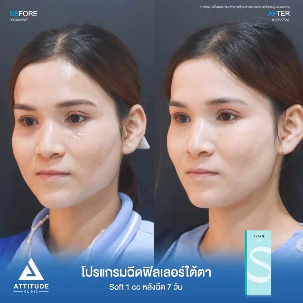 รีวิวโปรแกรมฉีดฟิลเลอร์ใต้ตาคุณน้ำตาล รุ่น S จำนวน 1 cc หลังฉีด 7 วัน เติมเต็มร่องใต้ตาให้อิ่มฟู แก้ใต้ตาหมองคล้ำทำกลับมาสดใส ลดริ้วรอยเล็กๆ ให้ตาตาดูเรียบเนียนที่ Attitude Clinic