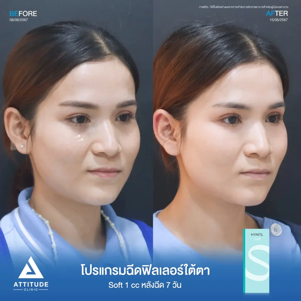 รีวิวโปรแกรมฉีดฟิลเลอร์ใต้ตาคุณน้ำตาล รุ่น S จำนวน 1 cc หลังฉีด 7 วัน เติมเต็มร่องใต้ตาให้อิ่มฟู แก้ใต้ตาหมองคล้ำทำกลับมาสดใส ลดริ้วรอยเล็กๆ ให้ตาตาดูเรียบเนียนที่ Attitude Clinic