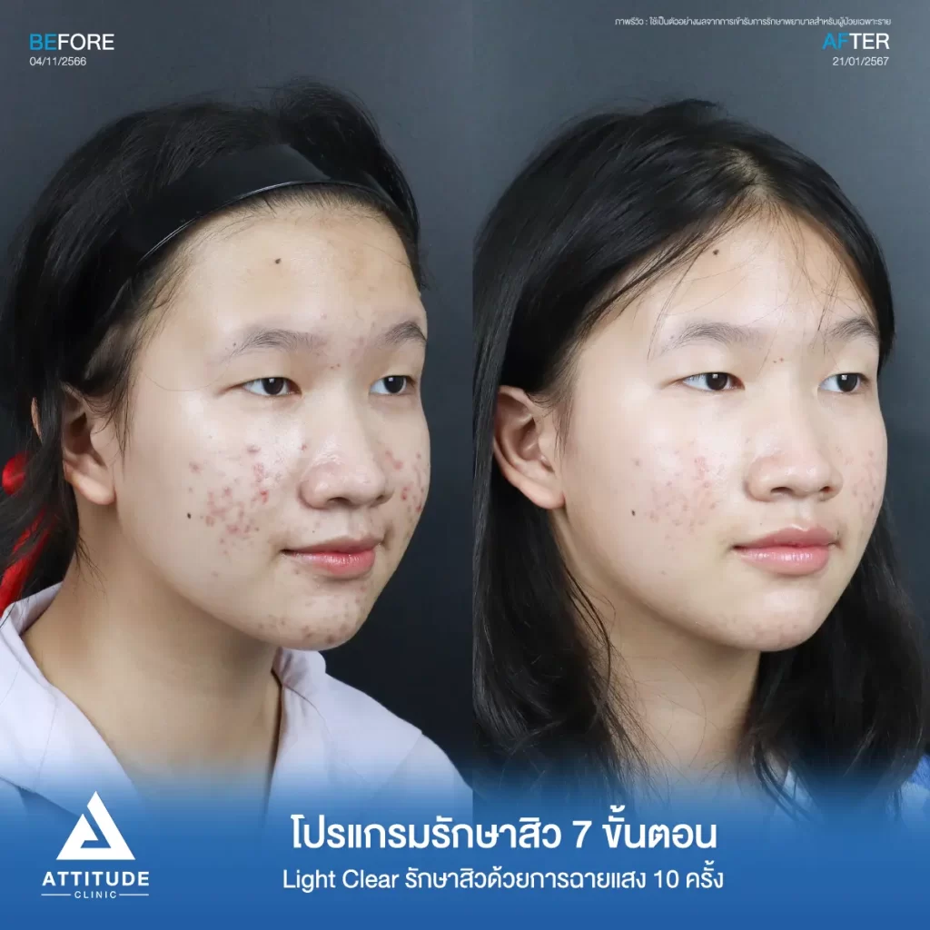 รีวิวรักษาสิวน้องตุ๊กตา ด้วยการฉายแสง Light Clear 7 ขั้นตอน จำนวน 10 ครั้ง รักษาสิวฮอร์โมน สิวอักเสบ สิวอุดตันเม็ดเล็กๆ รอยแดงทั่วใบหน้า โดยเฉพาะ 2 ข้างแก้ม และคางที่ Attitude Clinic