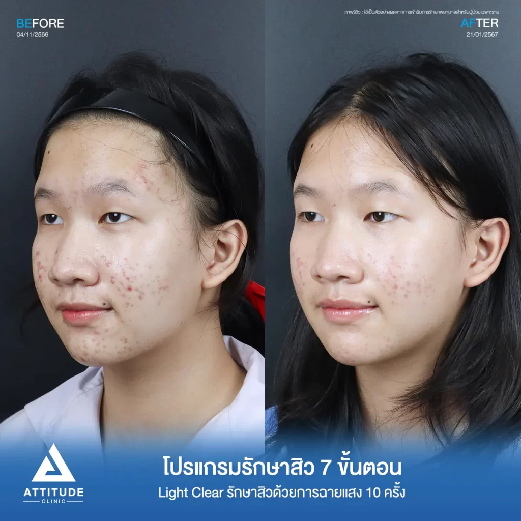 รีวิวรักษาสิวน้องตุ๊กตา ด้วยการฉายแสง Light Clear 7 ขั้นตอน จำนวน 10 ครั้ง รักษาสิวฮอร์โมน สิวอักเสบ สิวอุดตันเม็ดเล็กๆ รอยแดงทั่วใบหน้า โดยเฉพาะ 2 ข้างแก้ม และคางที่ Attitude Clinic