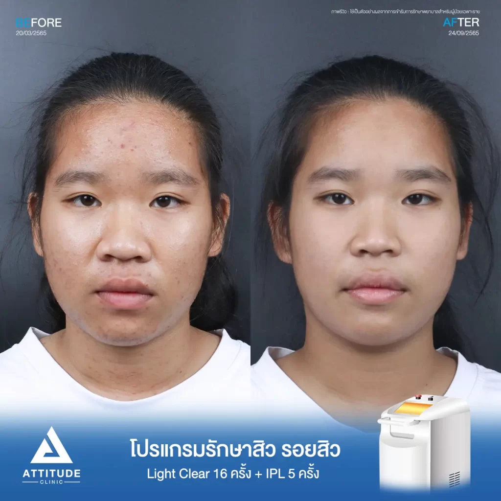 รีวิวรักษาสิวน้องณัฐชารีย์ ด้วยการฉายแสง Light Clear 7 ขั้นตอน จำนวน 16 ครั้ง และทำ IPL หน้าใส ลดรอยสิว จำนวน 5 ครั้ง รักษาสิวสิวอุดตัน สิวผดเม็ดเล็กๆ ทั่วใบหน้า และลำคอที่ Attitude Clinic