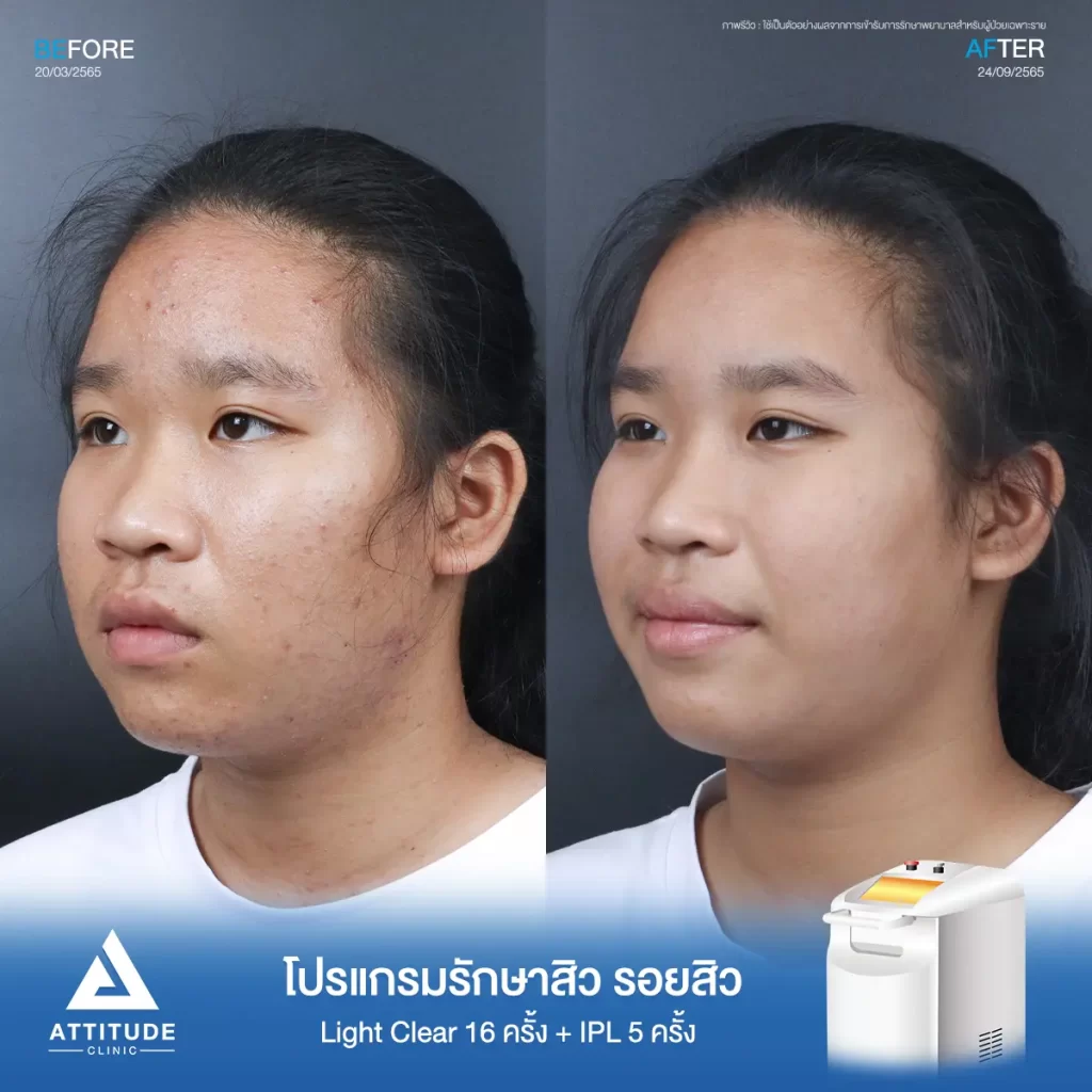 รีวิวรักษาสิวน้องณัฐชารีย์ ด้วยการฉายแสง Light Clear 7 ขั้นตอน จำนวน 16 ครั้ง และทำ IPL หน้าใส ลดรอยสิว จำนวน 5 ครั้ง รักษาสิวสิวอุดตัน สิวผดเม็ดเล็กๆ ทั่วใบหน้า และลำคอที่ Attitude Clinic