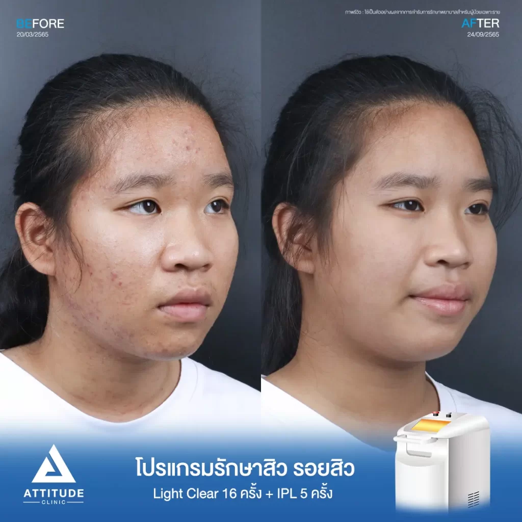 รีวิวรักษาสิวน้องณัฐชารีย์ ด้วยการฉายแสง Light Clear 7 ขั้นตอน จำนวน 16 ครั้ง และทำ IPL หน้าใส ลดรอยสิว จำนวน 5 ครั้ง รักษาสิวสิวอุดตัน สิวผดเม็ดเล็กๆ ทั่วใบหน้า และลำคอที่ Attitude Clinic