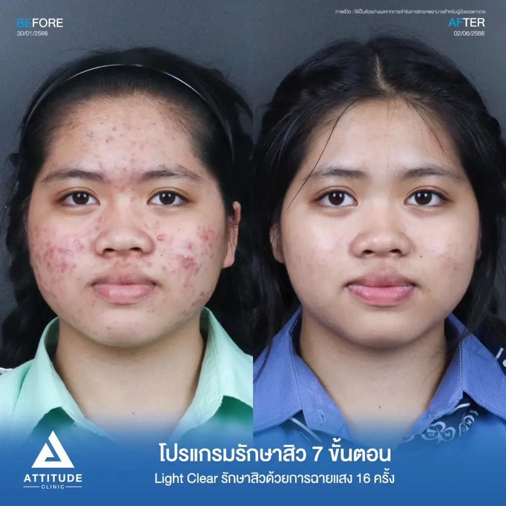 รีวิวรักษาสิวน้องจุฑารัตน์ ด้วยการฉายแสง Light Clear 7 ขั้นตอน จำนวน 16 ครั้ง รักษาสิวฮอร์โมน สิวอักเสบ สิวอุดตัน รอยแดงสิวทั่วใบหน้าที่ Attitude Clinic