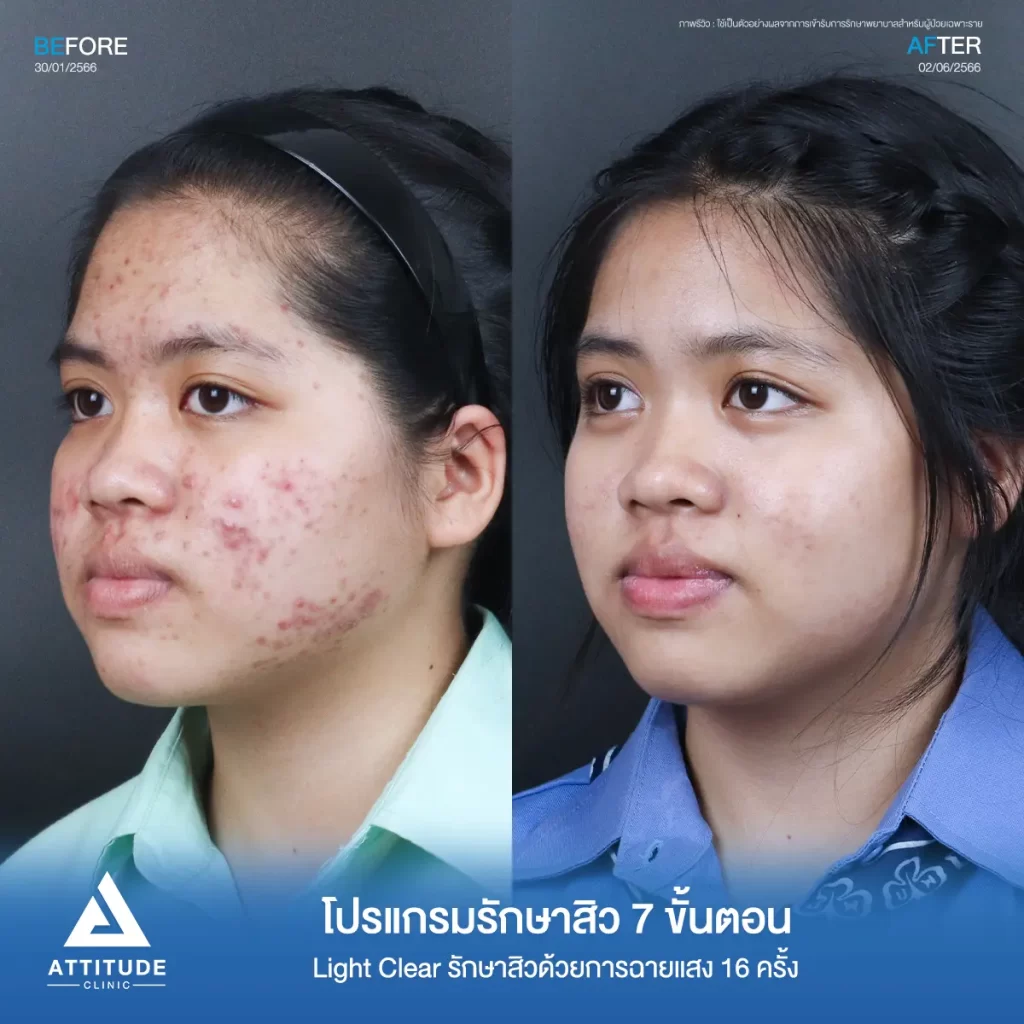 รีวิวรักษาสิวน้องจุฑารัตน์ ด้วยการฉายแสง Light Clear 7 ขั้นตอน จำนวน 16 ครั้ง รักษาสิวฮอร์โมน สิวอักเสบ สิวอุดตัน รอยแดงสิวทั่วใบหน้าที่ Attitude Clinic