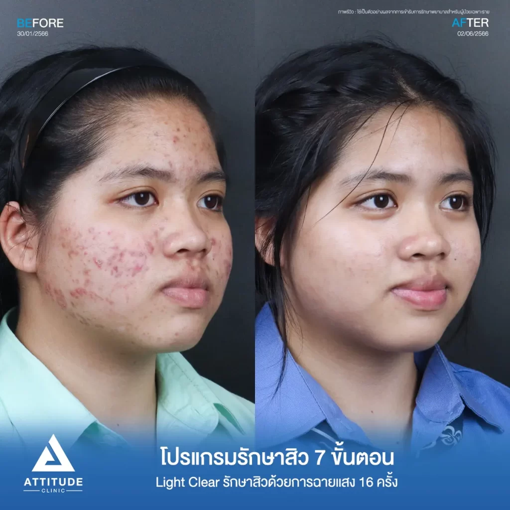 รีวิวรักษาสิวน้องจุฑารัตน์ ด้วยการฉายแสง Light Clear 7 ขั้นตอน จำนวน 16 ครั้ง รักษาสิวฮอร์โมน สิวอักเสบ สิวอุดตัน รอยแดงสิวทั่วใบหน้าที่ Attitude Clinic