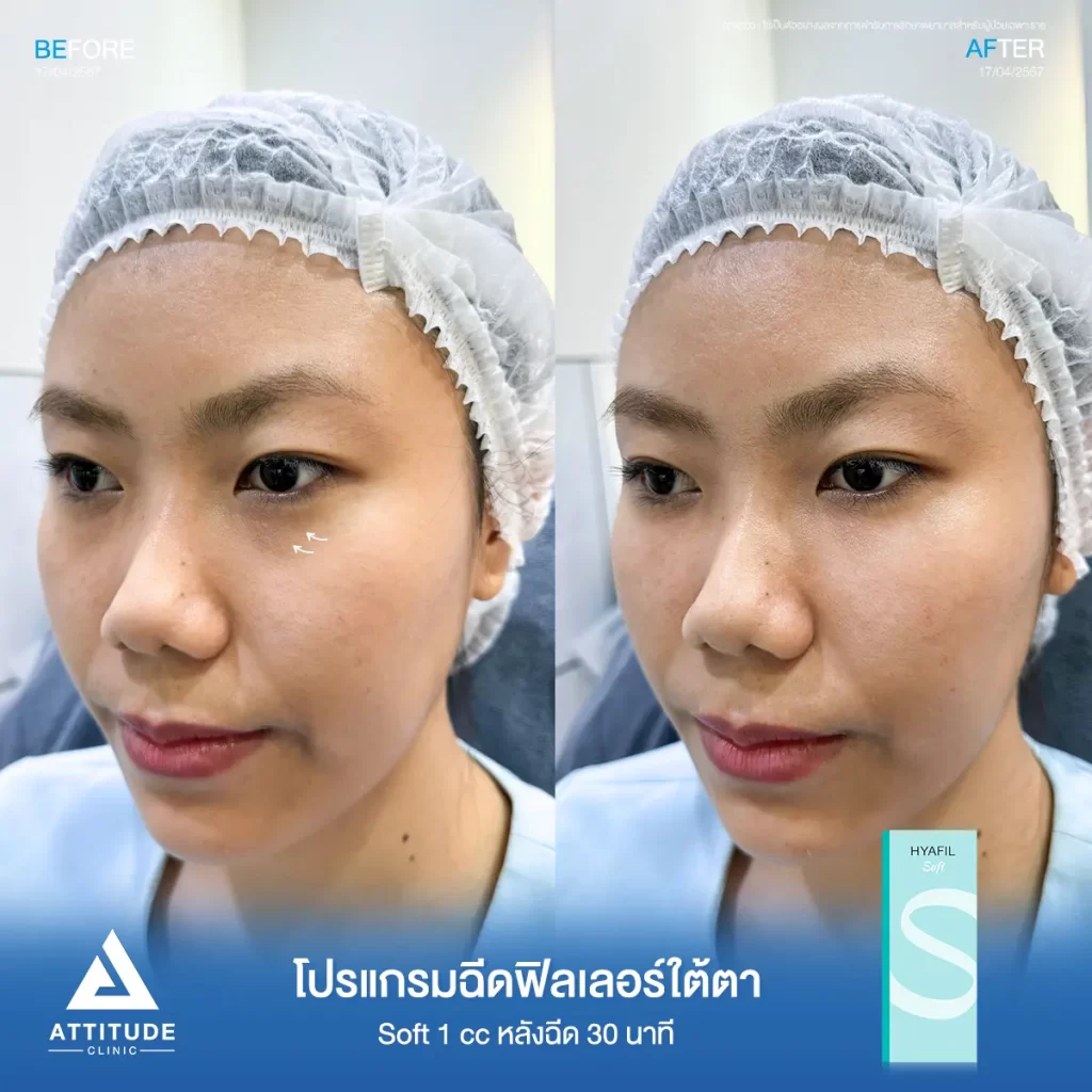 รีวิวโปรแกรมฉีดฟิลเลอร์ใต้ตาคุณแทน รุ่น S จำนวน 1 cc หลังฉีด 30 นาที เติมเต็มร่องใต้ตาให้อิ่มฟู ลดริ้วรอยเล็กๆ แก้ใต้ตาหมองคล้ำให้สดใส เรียบเนียน ดูเป็นธรรมชาติที่ Attitude Clinic