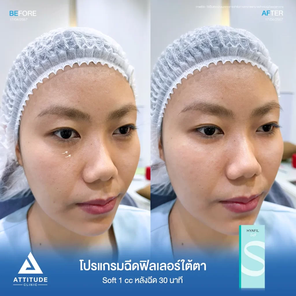 รีวิวโปรแกรมฉีดฟิลเลอร์ใต้ตาคุณแทน รุ่น S จำนวน 1 cc หลังฉีด 30 นาที เติมเต็มร่องใต้ตาให้อิ่มฟู ลดริ้วรอยเล็กๆ แก้ใต้ตาหมองคล้ำให้สดใส เรียบเนียน ดูเป็นธรรมชาติที่ Attitude Clinic