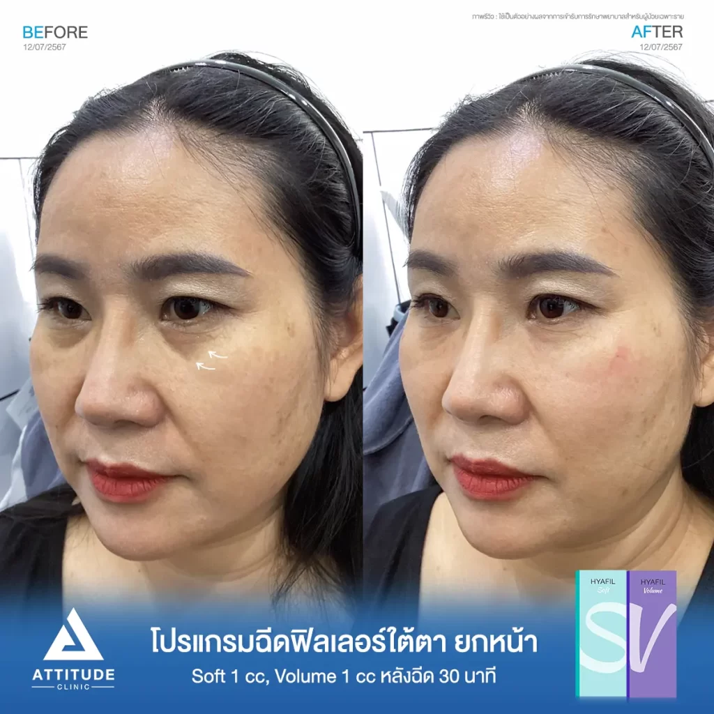 รีวิวโปรแกรมฉีดฟิลเลอร์ใต้ตา ยกหน้าคุณดวงเดือน รุ่น S และรุ่น V จำนวน 2 cc หลังฉีด 30 นาที เติมเต็มร่องลึกใต้ตาให้อิ่มฟู แก้ใต้ตาหมองคล้ำให้สดใส ลดริ้วรอยเล็กๆ รอบดวงตา ปรับรูปหน้า ยกกระชับผิวให้ดูอ่อนเยาว์เป็นธรรมชาติที่ Attitude Clinic