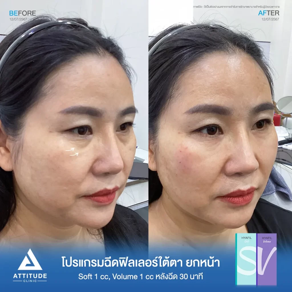 รีวิวโปรแกรมฉีดฟิลเลอร์ใต้ตา ยกหน้าคุณดวงเดือน รุ่น S และรุ่น V จำนวน 2 cc หลังฉีด 30 นาที เติมเต็มร่องลึกใต้ตาให้อิ่มฟู แก้ใต้ตาหมองคล้ำให้สดใส ลดริ้วรอยเล็กๆ รอบดวงตา ปรับรูปหน้า ยกกระชับผิวให้ดูอ่อนเยาว์เป็นธรรมชาติที่ Attitude Clinic