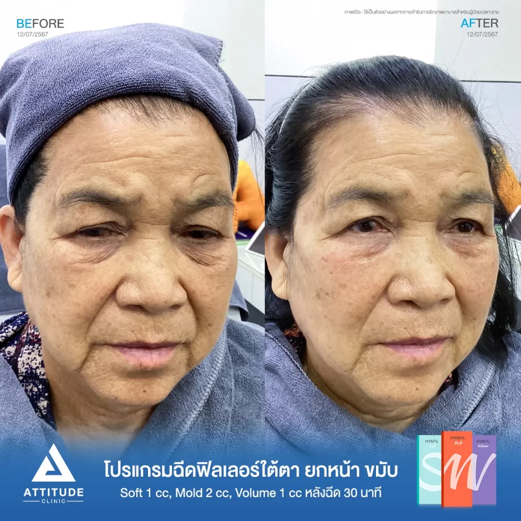 รีวิวโปรแกรมฉีดฟิลเลอร์ใต้ตา ยกหน้า ขมับ คุณวันดารุ่น S รุ่น M และรุ่น V จำนวน 4 cc หลังฉีด 30 นาที เติมเต็มร่องลึกใต้ตาให้อิ่มฟู ลดริ้วรอยเล็กๆ รอบดวงตา แก้ไข ปรับรูปหน้า แก้ปัญหาขมับตอบ ให้หน้าดูสดใสเป็นธรรมชาติที่ Attitude Clinic