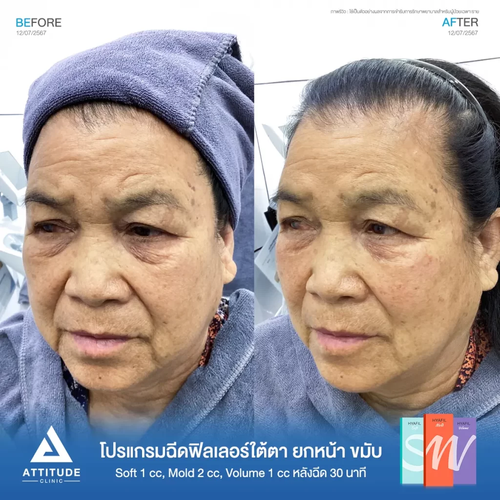 รีวิวโปรแกรมฉีดฟิลเลอร์ใต้ตา ยกหน้า ขมับ คุณวันดารุ่น S รุ่น M และรุ่น V จำนวน 4 cc หลังฉีด 30 นาที เติมเต็มร่องลึกใต้ตาให้อิ่มฟู ลดริ้วรอยเล็กๆ รอบดวงตา แก้ไข ปรับรูปหน้า แก้ปัญหาขมับตอบ ให้หน้าดูสดใสเป็นธรรมชาติที่ Attitude Clinic