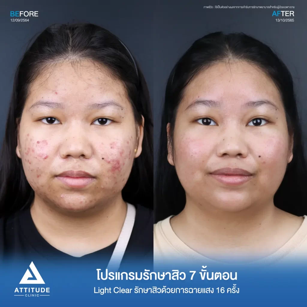 รีวิวรักษาสิวน้องฐิตาวรรณ ด้วยการฉายแสง โปรแกรมรักษาสิว Light Clear 7 ขั้นตอน จำนวน 10 ครั้ง สิวอักเสบหัวหนอง สิวอุดตัน รอยแดงทั่วใบหน้า โดยเฉพาะแก้ม 2 ข้างลามจนถึงต้นคอที่ Attitude Clinic