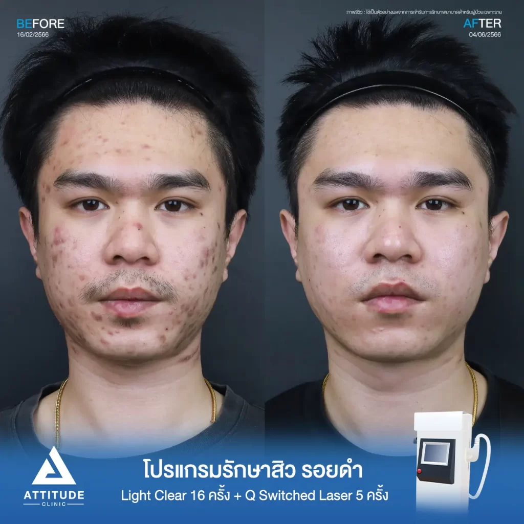 รีวิวรักษาสิวคุณนฤบดินทร์ด้วยการฉายแสง โปรแกรมรักษาสิว Light Clear 7 ขั้นตอน จำนวน 16 ครั้ง ทำ Q Switched Laser ลดรอยสิว จำนวน 5 ครั้ง รักษาสิวอุดตัน สิวอักเสบเม็ดใหญ่ รอยสิวดำจากสิวทั่วใบหน้าจนถึงคอที่ Attitude Clinic