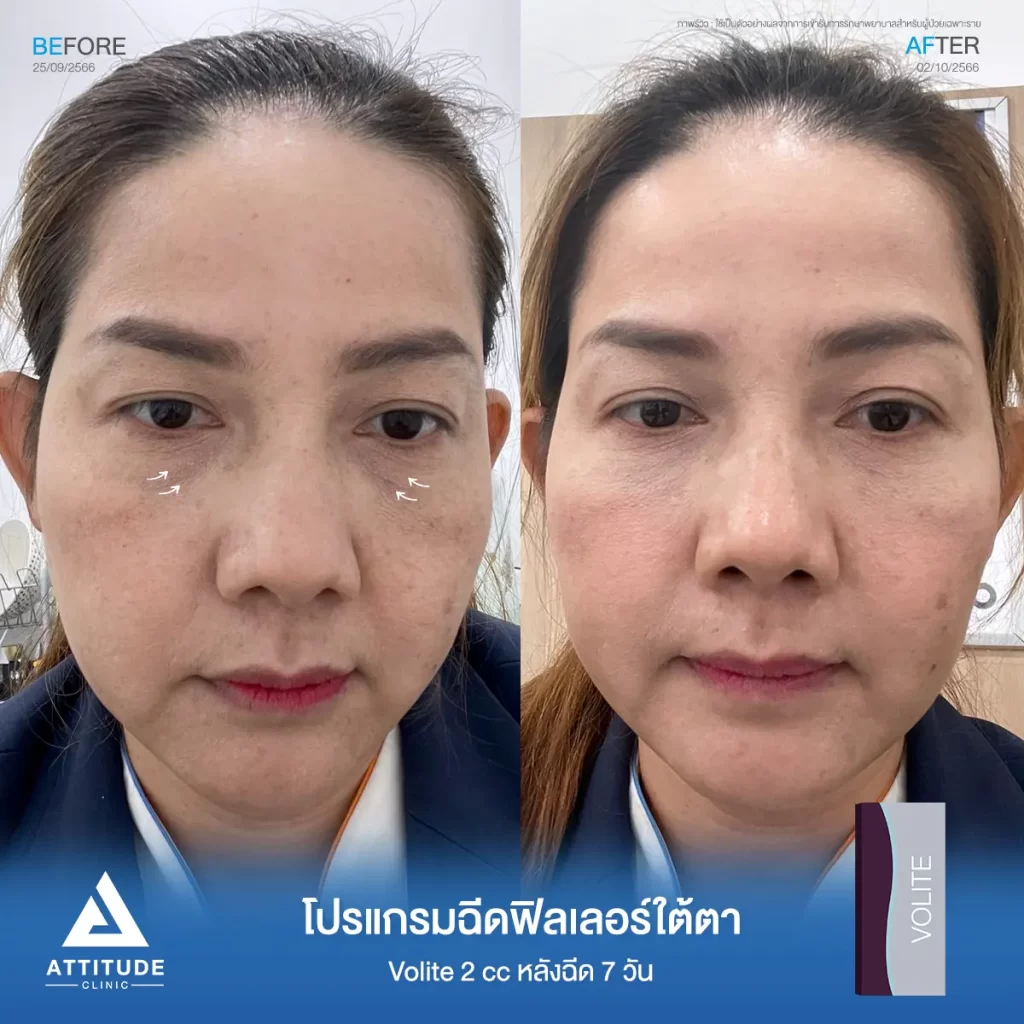 รีวิวโปรแกรมฉีดฟิลเลอร์ใต้ตาคุณแมว รุ่น Volite จำนวน 2 cc หลังฉีด 7 วัน เติมเต็มร่องลึกใต้ตา แก้ใต้ตาหมองคล้ำ ให้หน้ากลับมาสดใส ไม่โทรม และดูอ่อนเยาว์ลงที่ Attitude Clinic