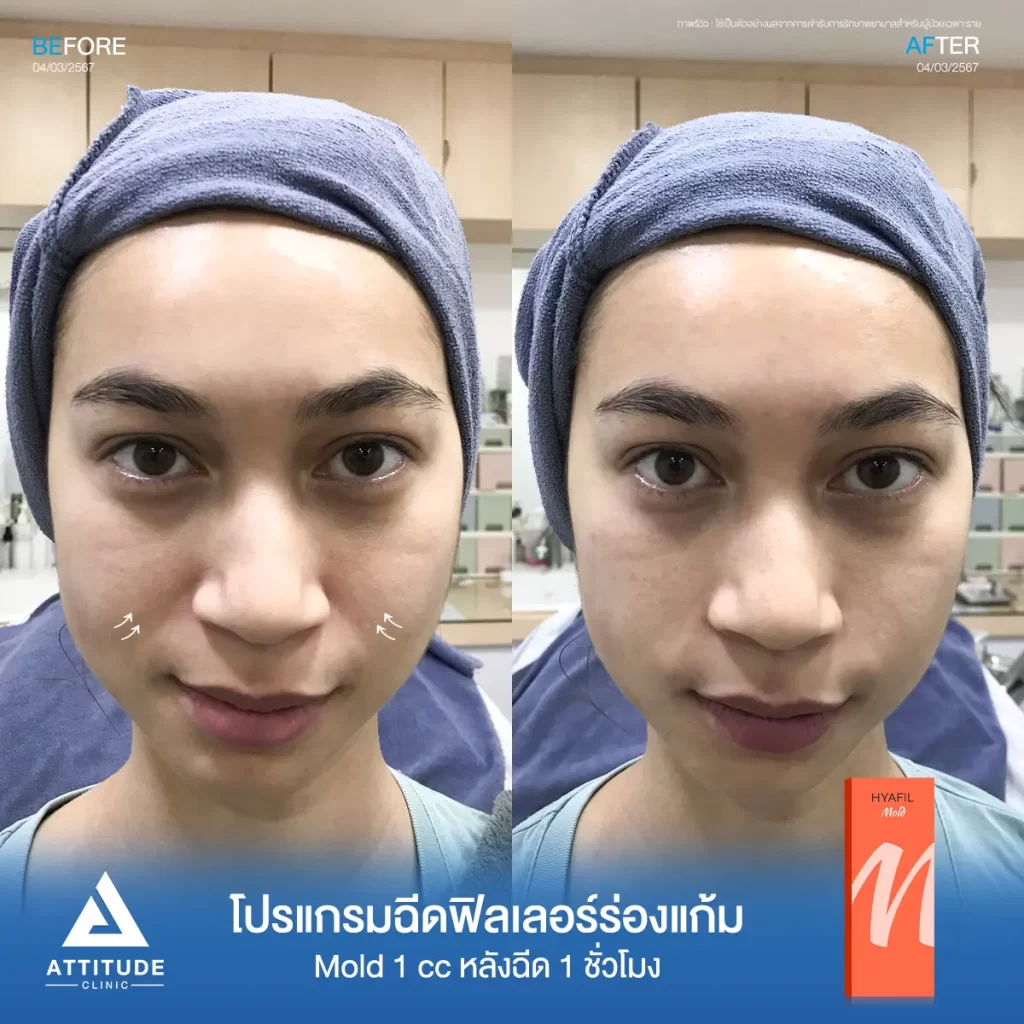 รีวิวโปรแกรมฉีดฟิลเลอร์ร่องแก้มคุณปารณีย์ รุ่น M จำนวน 1 cc หลังฉีด 1 ชั่วโมง ของคุณปารณีย์ เติมร่องแก้มให้อิ่มฟู ดูเต็มขึ้น แก้หน้าโทรมให้ดูสดใส ดูเป็นธรรมชาติที่ Attitude Clinic