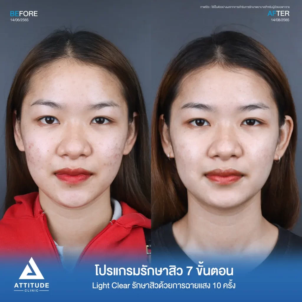 รีวิวรักษาสิวคุณจารวี ด้วยการฉายแสง Light Clear 7 ขั้นตอน จำนวน 10 ครั้ง รักษาสิวอุดตัน สิวผดเม็ดเล็กๆ และรอยแดงทั่วใบหน้าที่ Attitude Clinic