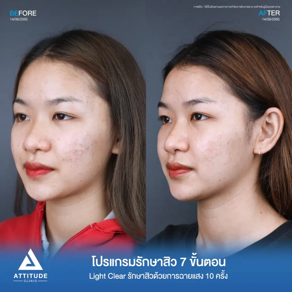 รีวิวรักษาสิวคุณจารวี ด้วยการฉายแสง Light Clear 7 ขั้นตอน จำนวน 10 ครั้ง รักษาสิวอุดตัน สิวผดเม็ดเล็กๆ และรอยแดงทั่วใบหน้าที่ Attitude Clinic