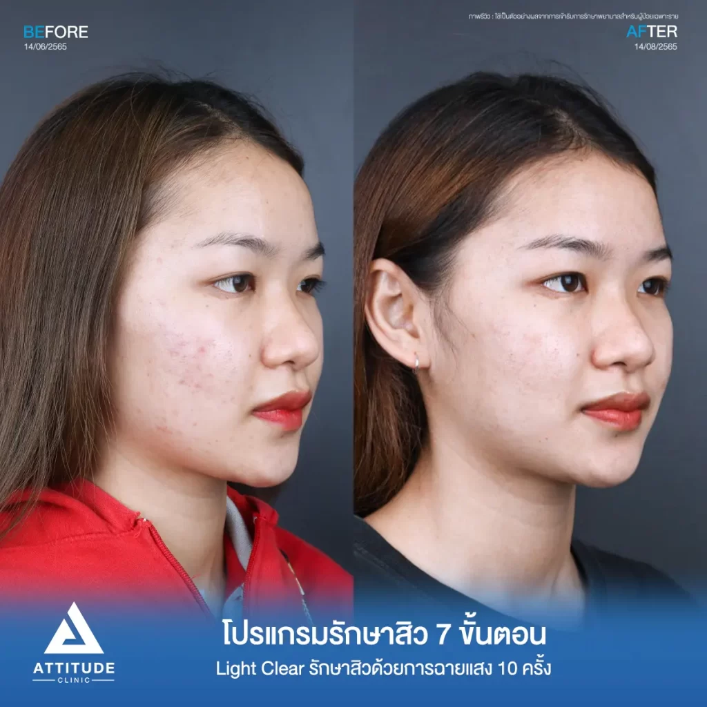 รีวิวรักษาสิวคุณจารวี ด้วยการฉายแสง Light Clear 7 ขั้นตอน จำนวน 10 ครั้ง รักษาสิวอุดตัน สิวผดเม็ดเล็กๆ และรอยแดงทั่วใบหน้าที่ Attitude Clinic