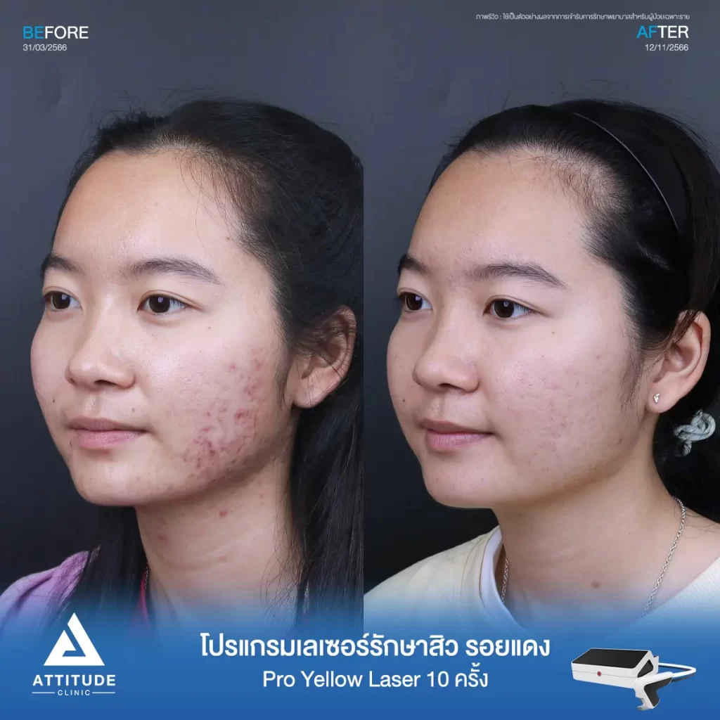 รีวิวรักษารอยสิวคุณศรุดา ด้วยโปรแกรม Pro Yellow Laser จำนวน 10 ครั้ง ลดรอยแดงจากสิว สิวอักเสบ บริเวณแก้ม 2 ข้าง และคอที่ Attitude Clinic