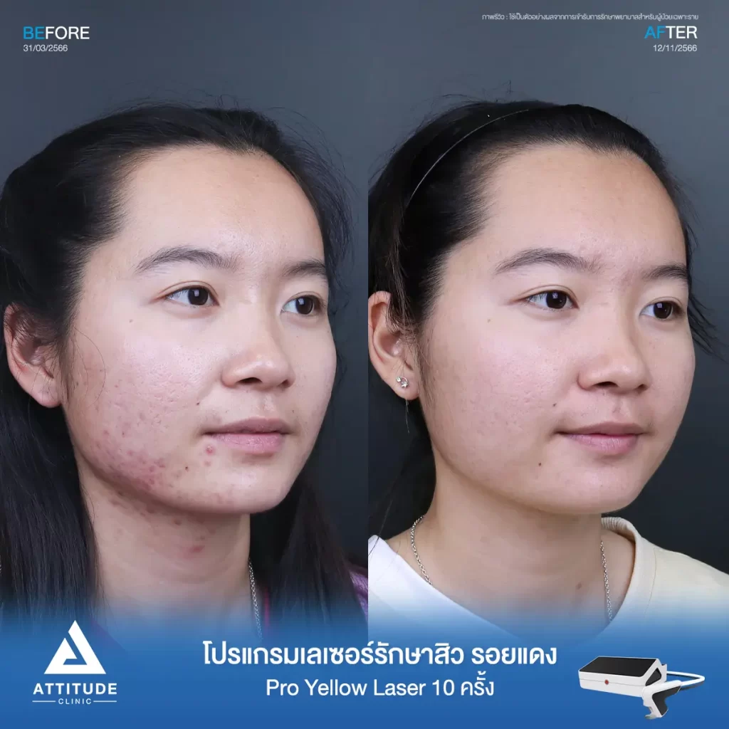 รีวิวรักษารอยสิวคุณศรุดา ด้วยโปรแกรม Pro Yellow Laser จำนวน 10 ครั้ง ลดรอยแดงจากสิว สิวอักเสบ บริเวณแก้ม 2 ข้าง และคอที่ Attitude Clinic