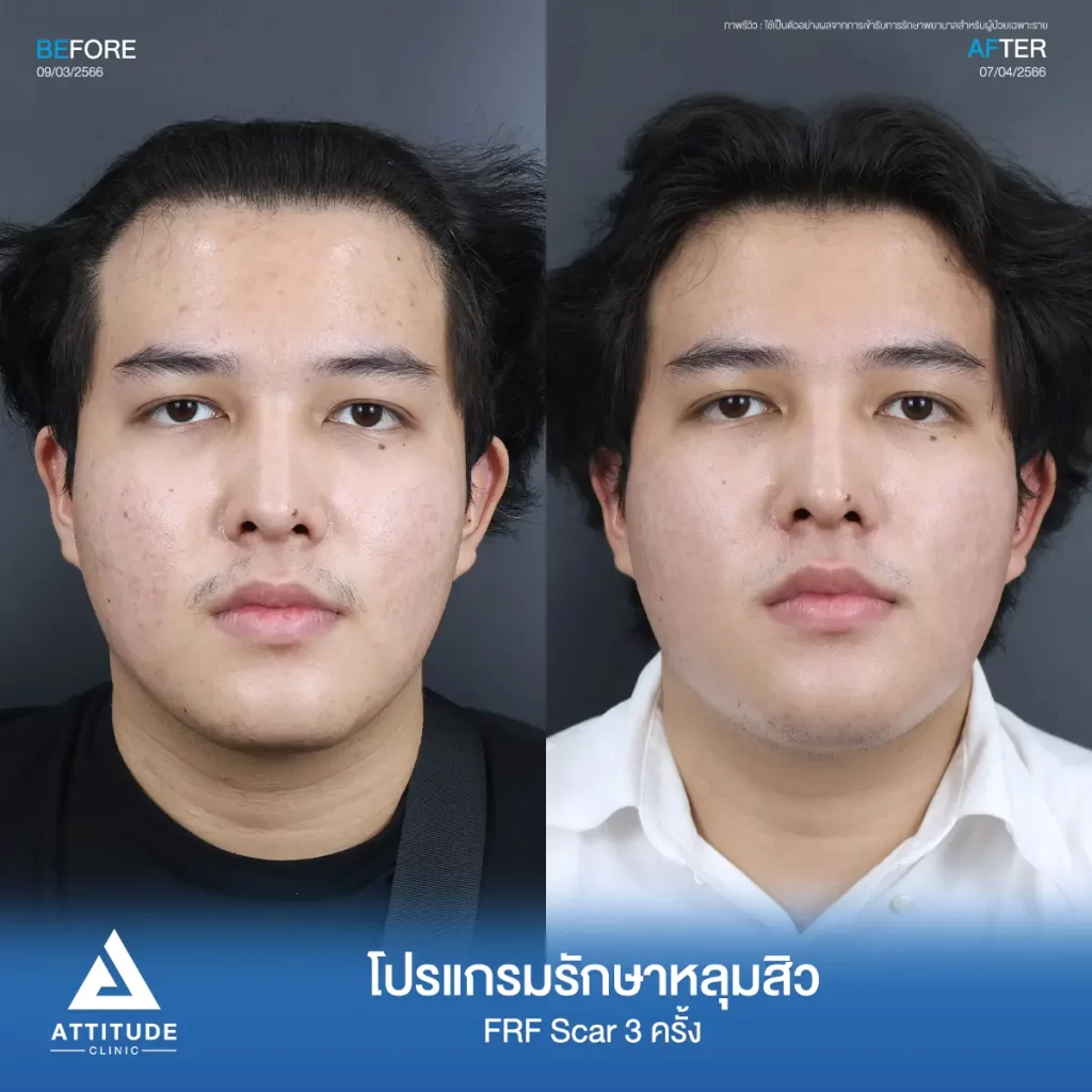 รีวิวรักษาหลุมสิวคุณเมฆ FRF Scar จำนวน 3 ครั้ง รักษาหลุมสิว กระชับรูขุมขนทั่วใบหน้า โดยเฉพาะบริเวณหน้าแก้ม 2 ข้าง และหน้าผากที่ Attitude Clinic