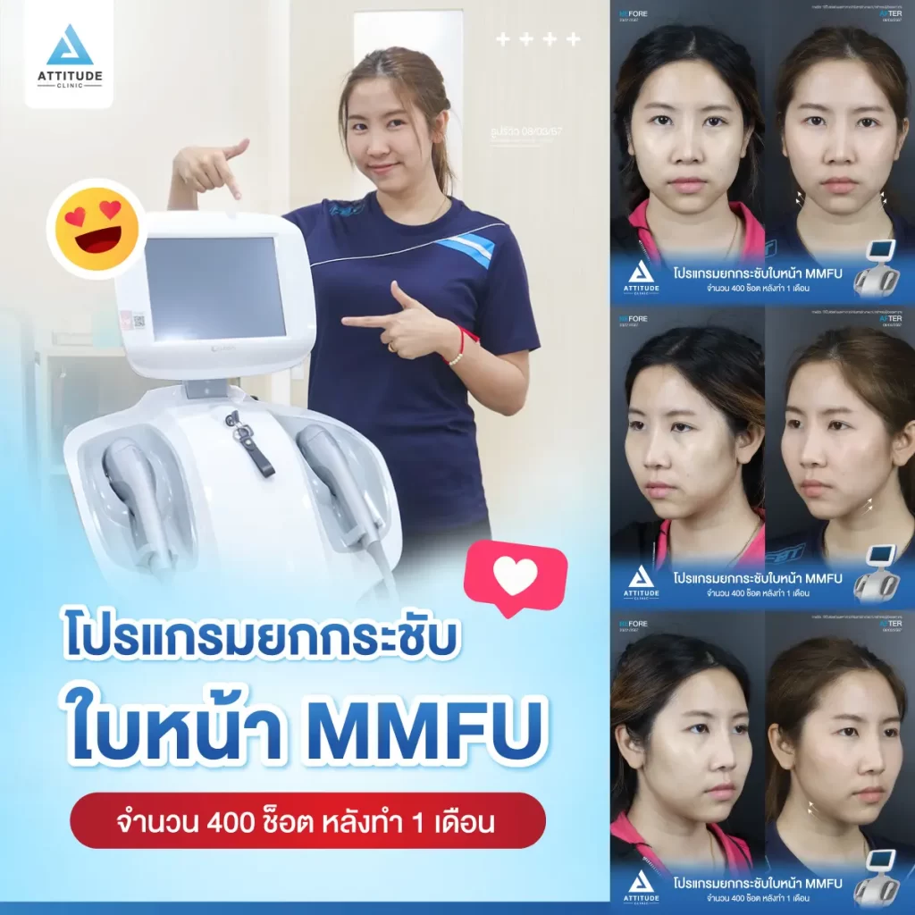 รีวิวโปรแกรมยกกระชับใบหน้า MMFU คุณปุ๊กกี้ จำนวน 400 ช็อต หลังทำ 1 เดือน ยกกระชับผิวบริเวณข้างแก้ม หน้าแก้ม เห็นกรอบหน้าชัดขึ้น หน้าเรียวสวยขึ้นที่ Attitude Clinic