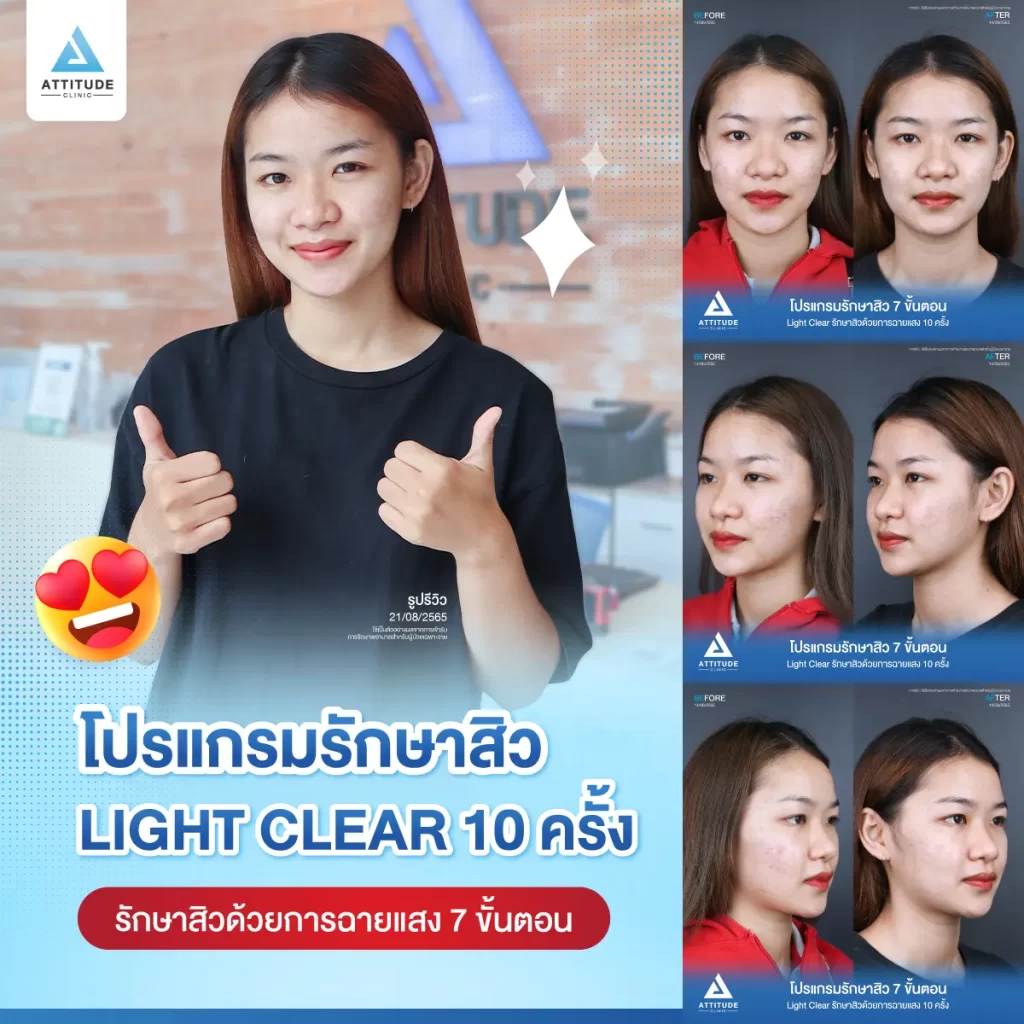 รีวิวรักษาสิวคุณจารวี ด้วยการฉายแสง Light Clear 7 ขั้นตอน จำนวน 10 ครั้ง รักษาสิวอุดตัน สิวผดเม็ดเล็กๆ และรอยแดงทั่วใบหน้าที่ Attitude Clinic