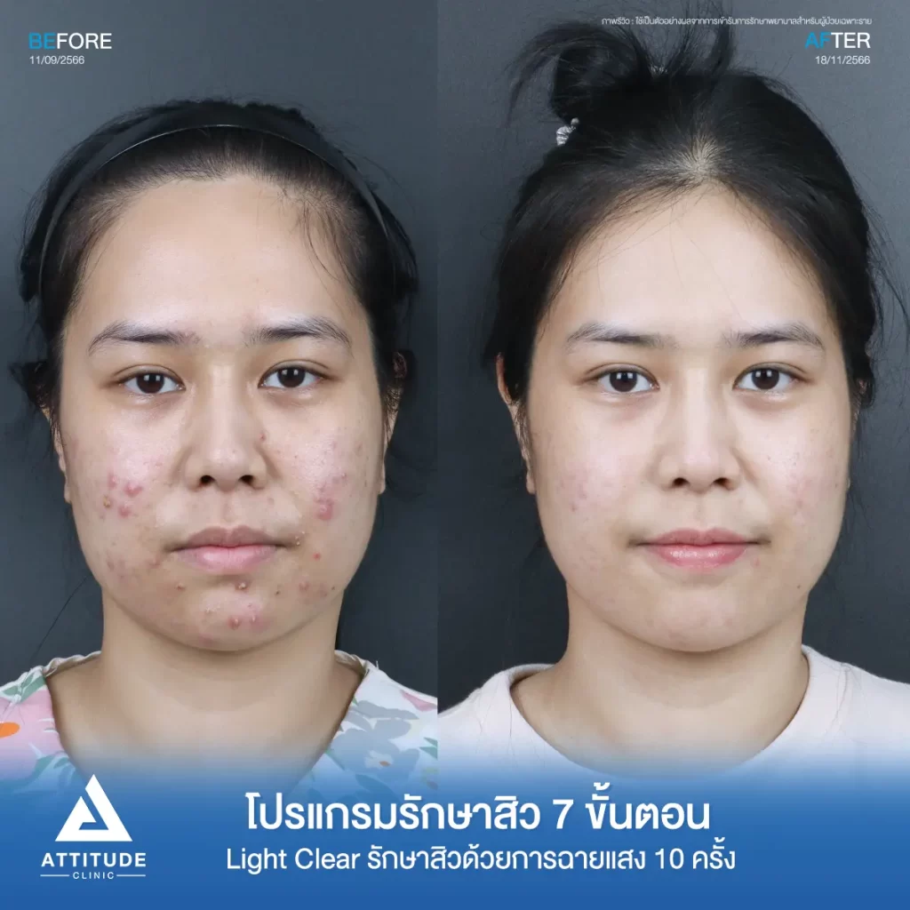 รีวิวรักษาสิวคุณเอ ด้วยการฉายแสง โปรแกรมรักษาสิว Light Clear 7 ขั้นตอน จำนวน 10 ครั้ง รักษาสิวอักเสบ สิวหัวหนองเม็ดใหญ่ๆ บริเวณแก้มสองข้าง และคางที่ Attitude Clinic