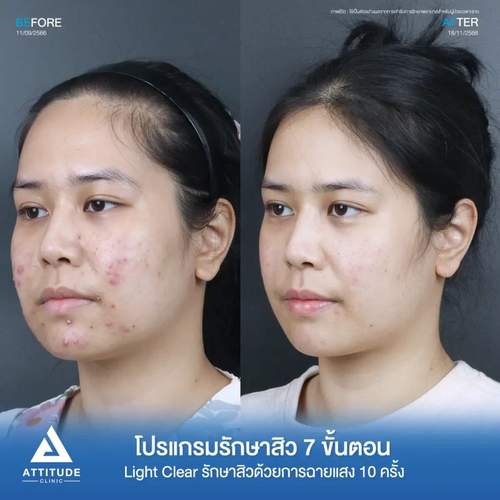 รีวิวรักษาสิวคุณเอ ด้วยการฉายแสง โปรแกรมรักษาสิว Light Clear 7 ขั้นตอน จำนวน 10 ครั้ง รักษาสิวอักเสบ สิวหัวหนองเม็ดใหญ่ๆ บริเวณแก้มสองข้าง และคางที่ Attitude Clinic