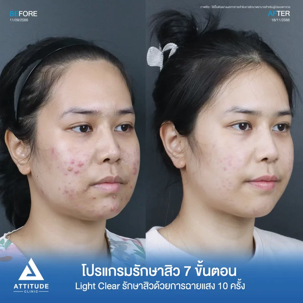 รีวิวรักษาสิวคุณเอ ด้วยการฉายแสง โปรแกรมรักษาสิว Light Clear 7 ขั้นตอน จำนวน 10 ครั้ง รักษาสิวอักเสบ สิวหัวหนองเม็ดใหญ่ๆ บริเวณแก้มสองข้าง และคางที่ Attitude Clinic