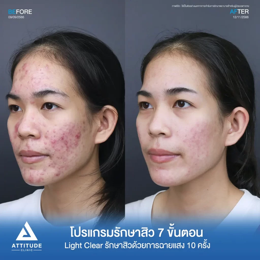 รีวิวรักษาสิวน้องโนนี่ ด้วยการฉายแสง โปรแกรมรักษาสิว Light Clear 7 ขั้นตอน จำนวน 10 ครั้ง รักษาสิวอักเสบ สิวหัวหนองเม็ดใหญ่ๆ สิวอุดตัน รอยแดงทั่วใบหน้าที่ Attitude Clinic