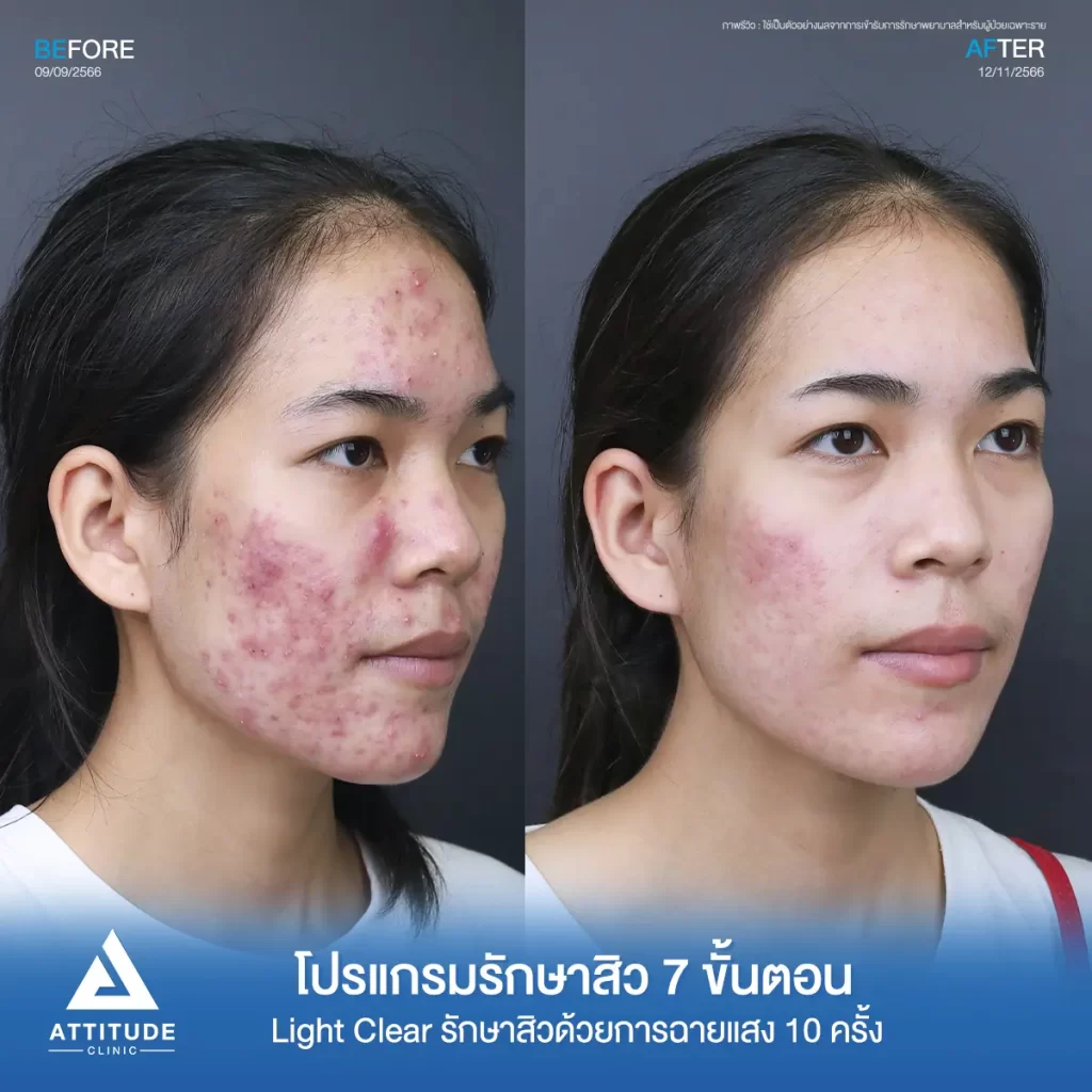 รีวิวรักษาสิวน้องโนนี่ ด้วยการฉายแสง โปรแกรมรักษาสิว Light Clear 7 ขั้นตอน จำนวน 10 ครั้ง รักษาสิวอักเสบ สิวหัวหนองเม็ดใหญ่ๆ สิวอุดตัน รอยแดงทั่วใบหน้าที่ Attitude Clinic