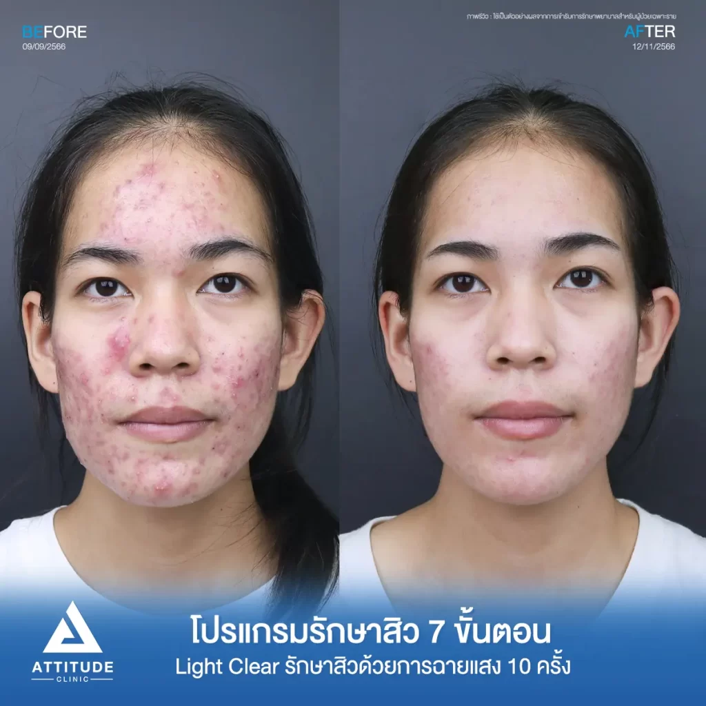 รีวิวรักษาสิวน้องโนนี่ ด้วยการฉายแสง โปรแกรมรักษาสิว Light Clear 7 ขั้นตอน จำนวน 10 ครั้ง รักษาสิวอักเสบ สิวหัวหนองเม็ดใหญ่ๆ สิวอุดตัน รอยแดงทั่วใบหน้าที่ Attitude Clinic