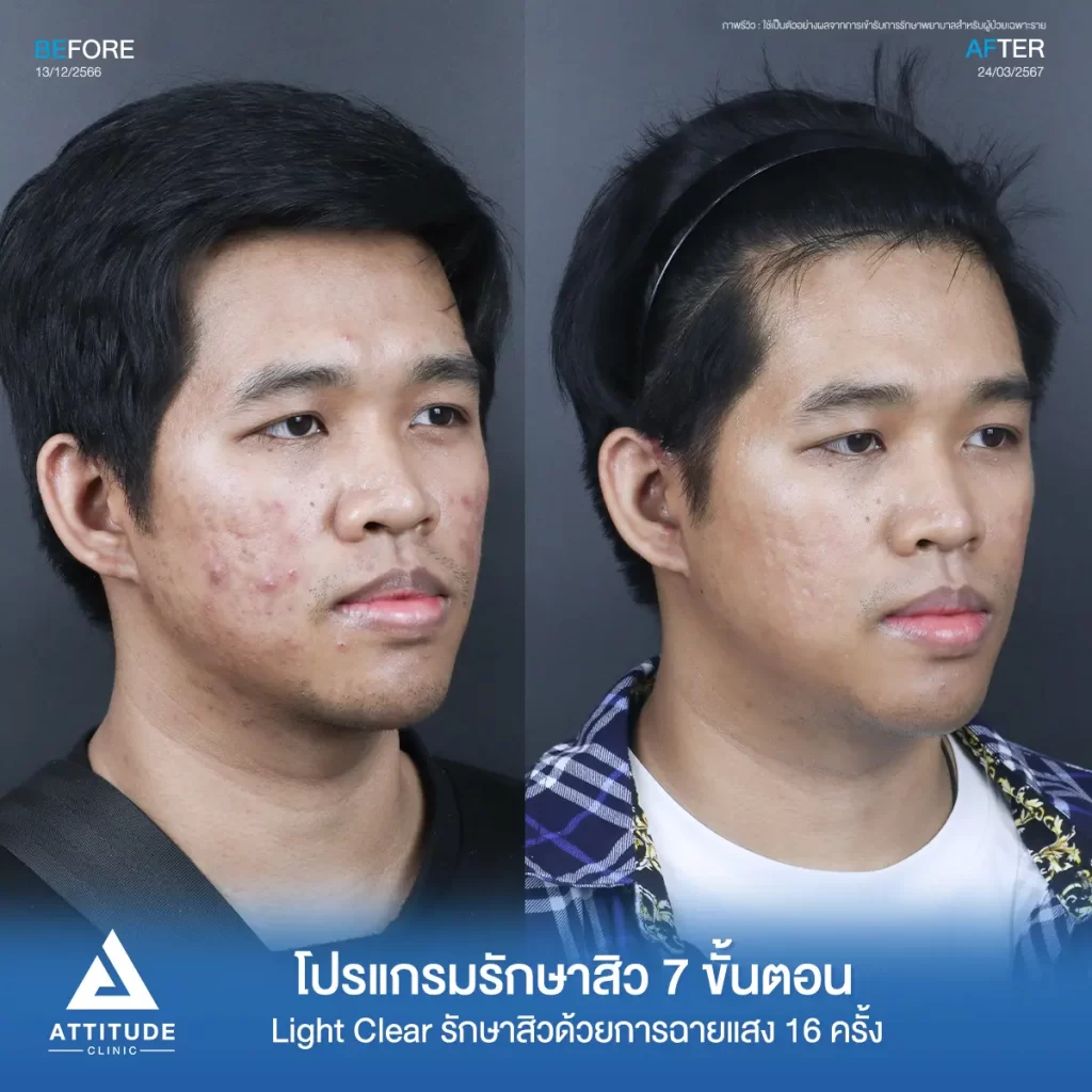 รีวิวรักษาสิวคุณท็อป ด้วยการฉายแสง โปรแกรมรักษาสิว Light Clear 7 ขั้นตอน จำนวน 16 ครั้ง รักษาสิวอักเสบ สิวหัวหนองเม็ดใหญ่ๆ สิวอุดตัน รอยแดงบริเวณแก้ม 2 ข้างที่ Attitude Clinic