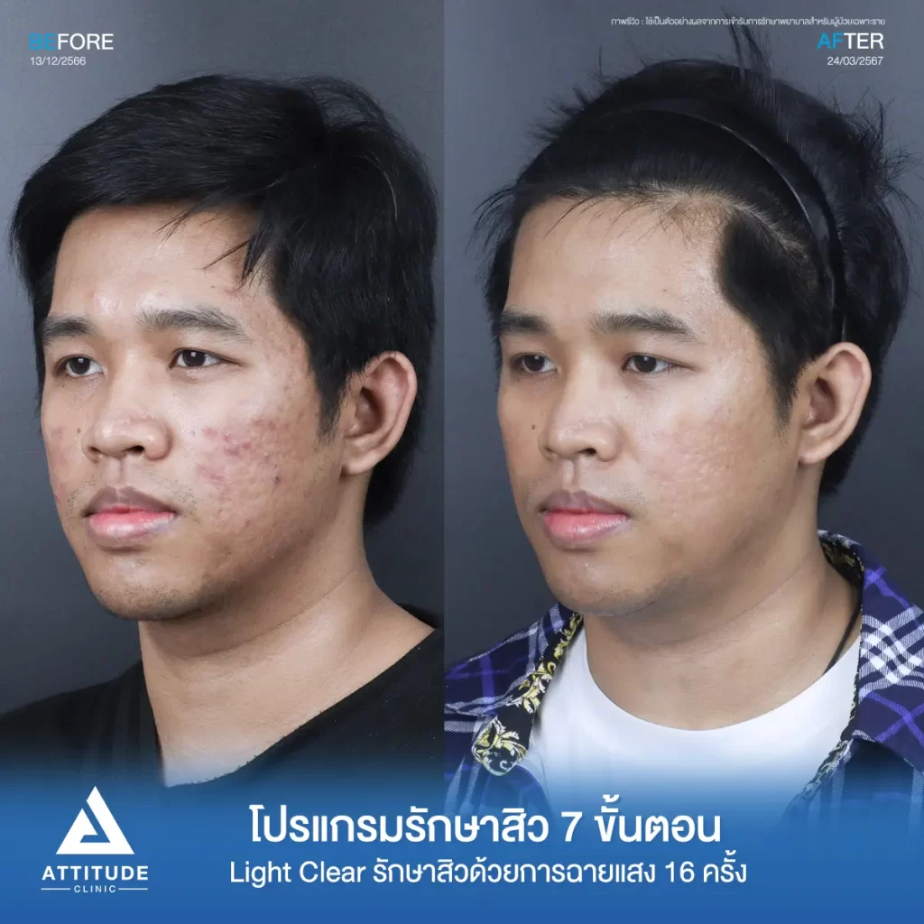 รีวิวรักษาสิวคุณท็อป ด้วยการฉายแสง โปรแกรมรักษาสิว Light Clear 7 ขั้นตอน จำนวน 16 ครั้ง รักษาสิวอักเสบ สิวหัวหนองเม็ดใหญ่ๆ สิวอุดตัน รอยแดงบริเวณแก้ม 2 ข้างที่ Attitude Clinic