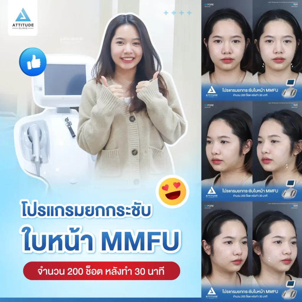 รีวิวโปรแกรมยกกระชับใบหน้า MMFU คุณแป้งร่ำ จำนวน 200 ช็อต หลังทำ 30 นาที ยกกระชับผิว และสลายไขมันบริเวณข้างแก้ม หน้าแก้ม เก็บเหนียงใต้คาง หน้าดูเรียวขึ้น เห็นกรอบหน้าชัดขึ้นที่ Attitude Clinic