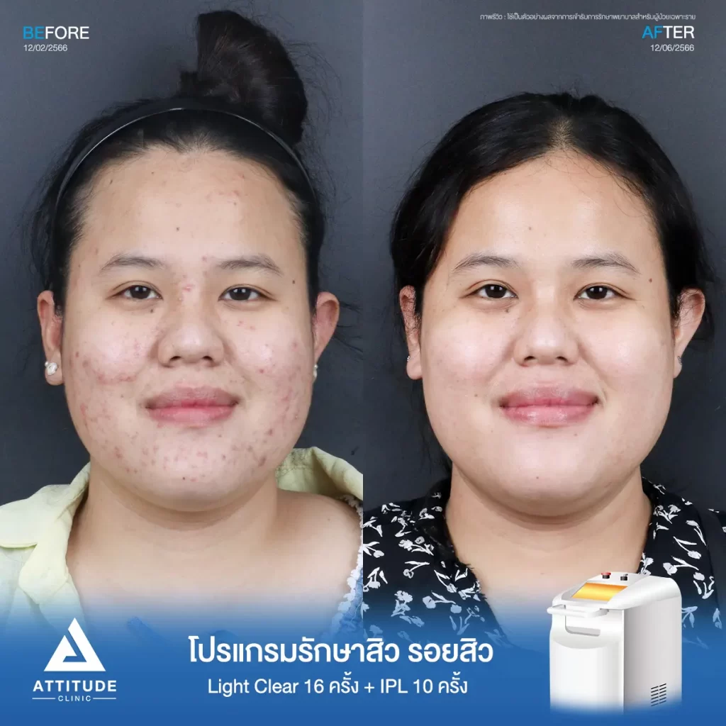 รีวิวรักษาสิวคุณนุ่น ด้วยการฉายแสง โปรแกรมรักษาสิว Light Clear 7 ขั้นตอน จำนวน 16 ครั้ง และโปรแกรม IPL หน้าใส จำนวน 10 ครั้ง รักษาสิวอักเสบ สิวอุดตัน และรอยแดงสิวทั่วใบหน้าที่ Attitude Clinic