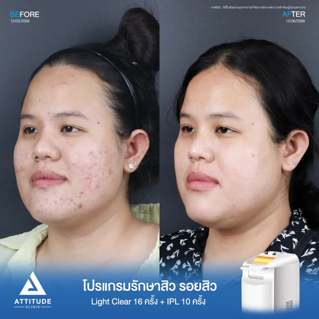 รีวิวรักษาสิวคุณนุ่น ด้วยการฉายแสง โปรแกรมรักษาสิว Light Clear 7 ขั้นตอน จำนวน 16 ครั้ง และโปรแกรม IPL หน้าใส จำนวน 10 ครั้ง รักษาสิวอักเสบ สิวอุดตัน และรอยแดงสิวทั่วใบหน้าที่ Attitude Clinic