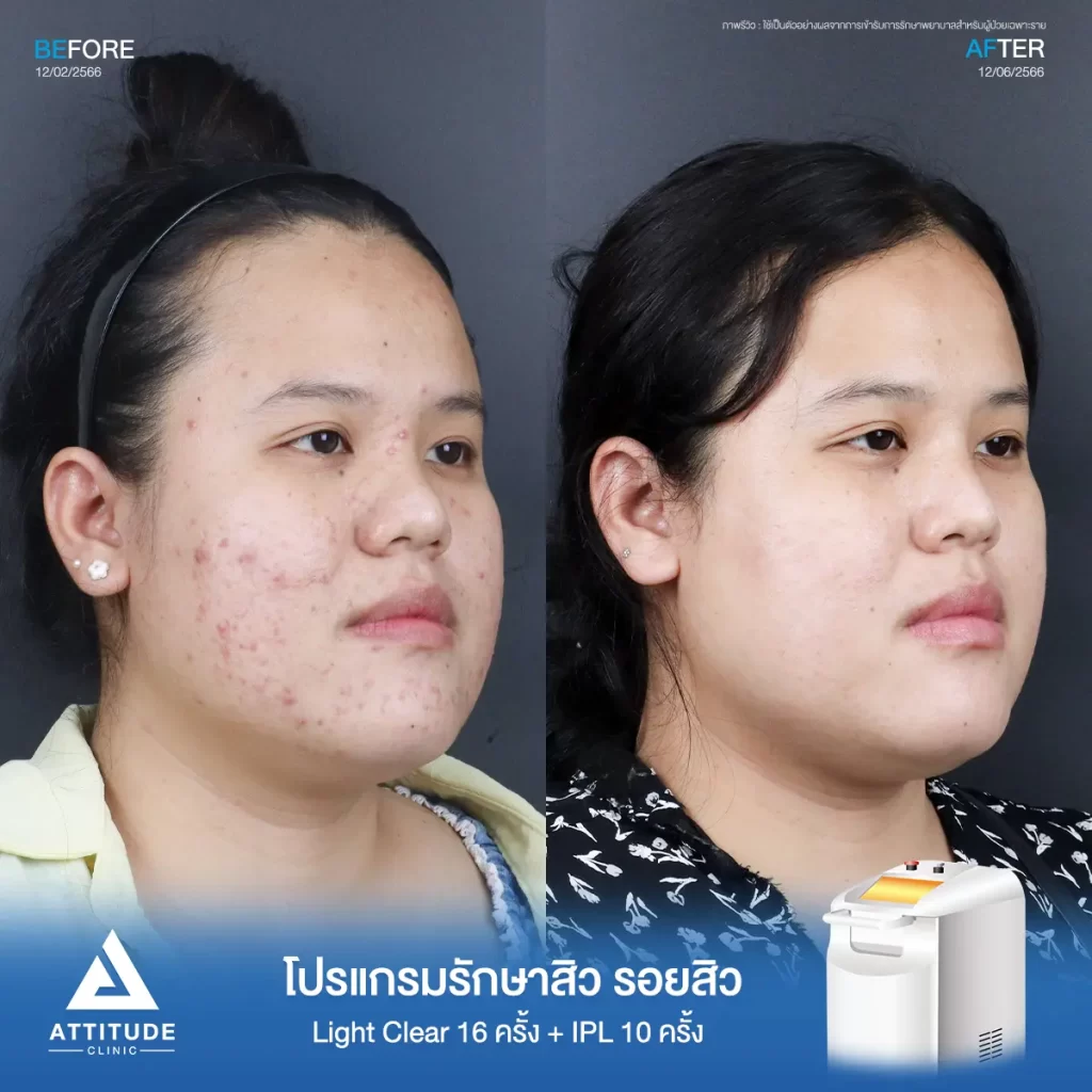 รีวิวรักษาสิวคุณนุ่น ด้วยการฉายแสง โปรแกรมรักษาสิว Light Clear 7 ขั้นตอน จำนวน 16 ครั้ง และโปรแกรม IPL หน้าใส จำนวน 10 ครั้ง รักษาสิวอักเสบ สิวอุดตัน และรอยแดงสิวทั่วใบหน้าที่ Attitude Clinic