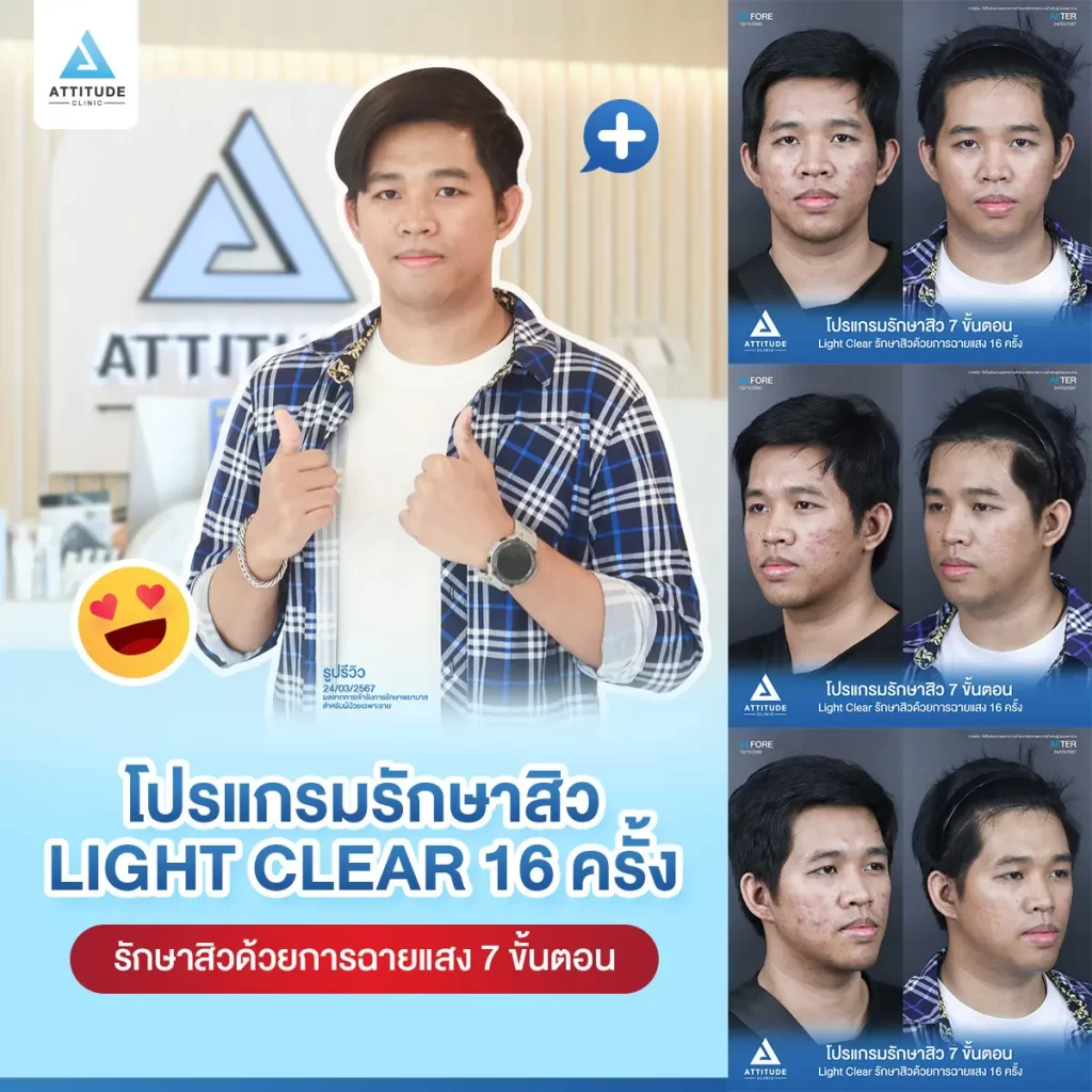 รีวิวรักษาสิวคุณท็อป ด้วยการฉายแสง โปรแกรมรักษาสิว Light Clear 7 ขั้นตอน จำนวน 16 ครั้ง รักษาสิวอักเสบ สิวหัวหนองเม็ดใหญ่ๆ สิวอุดตัน รอยแดงบริเวณแก้ม 2 ข้างที่ Attitude Clinic