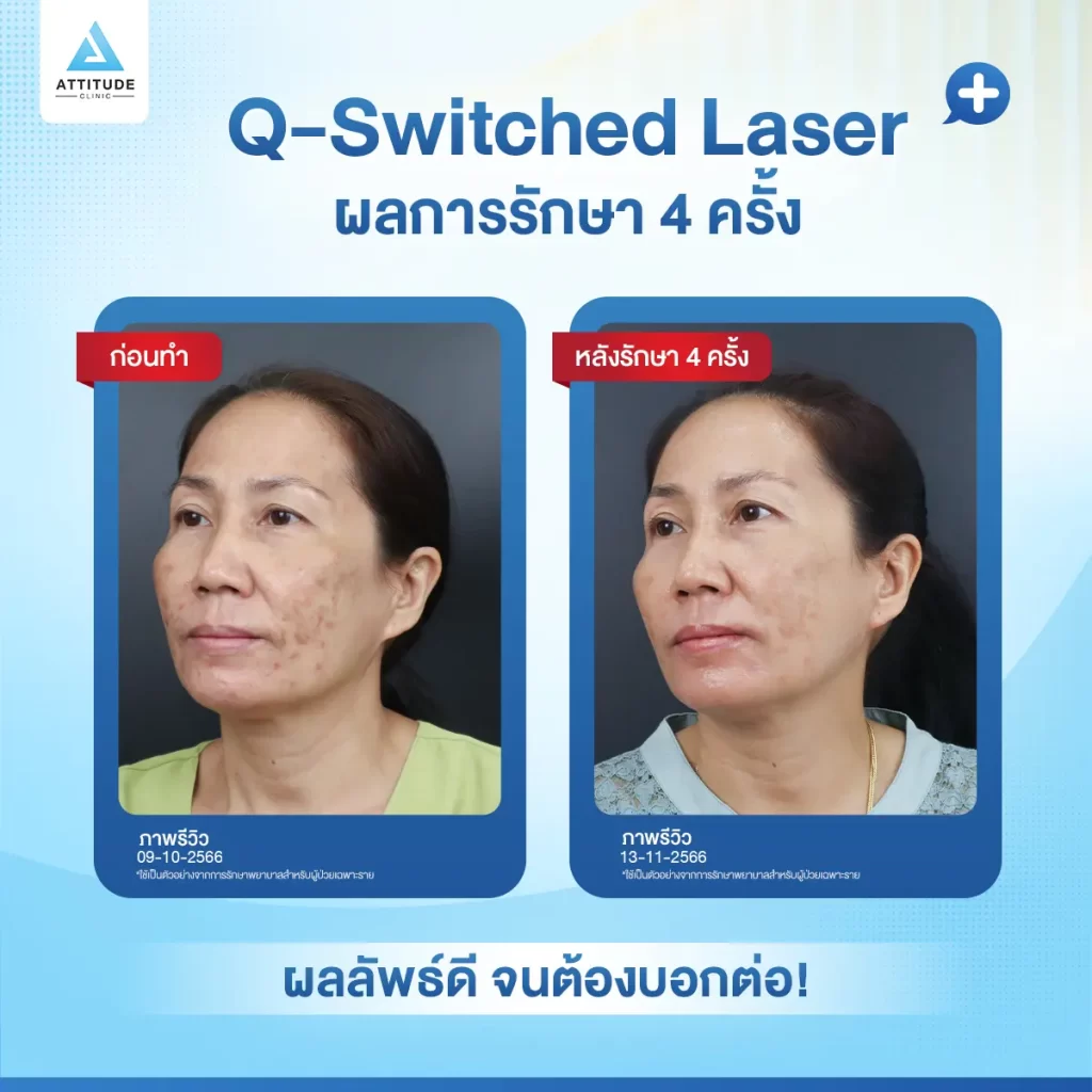 พร้อมออกเที่ยว แต่ผิวหน้ามีปัญหา! ต้องให้คุณหมอช่วยดูแล รักษารอยดำ รอยสิว ฝ้า กระ ด้วย Q-Switched Laser เครื่องได้มาตรฐาน หมอดูแลเองทุกเคส ได้ผลลัพธ์หลังทำเป็นที่น่าพอใจ จนต้องบอกต่อ!