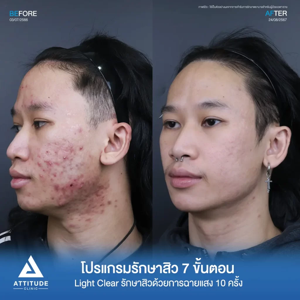 รีวิวรักษาสิวคุณบดินทร์ ด้วยการฉายแสง โปรแกรมรักษาสิว Light Clear 7 ขั้นตอน จำนวน 10 ครั้ง รักษาสิวอักเสบเม็ดใหญ่ สิวหนอง รอยแดงทั่วใบหน้าลามลงมาถึงต้นคอที่ Attitude Clinic