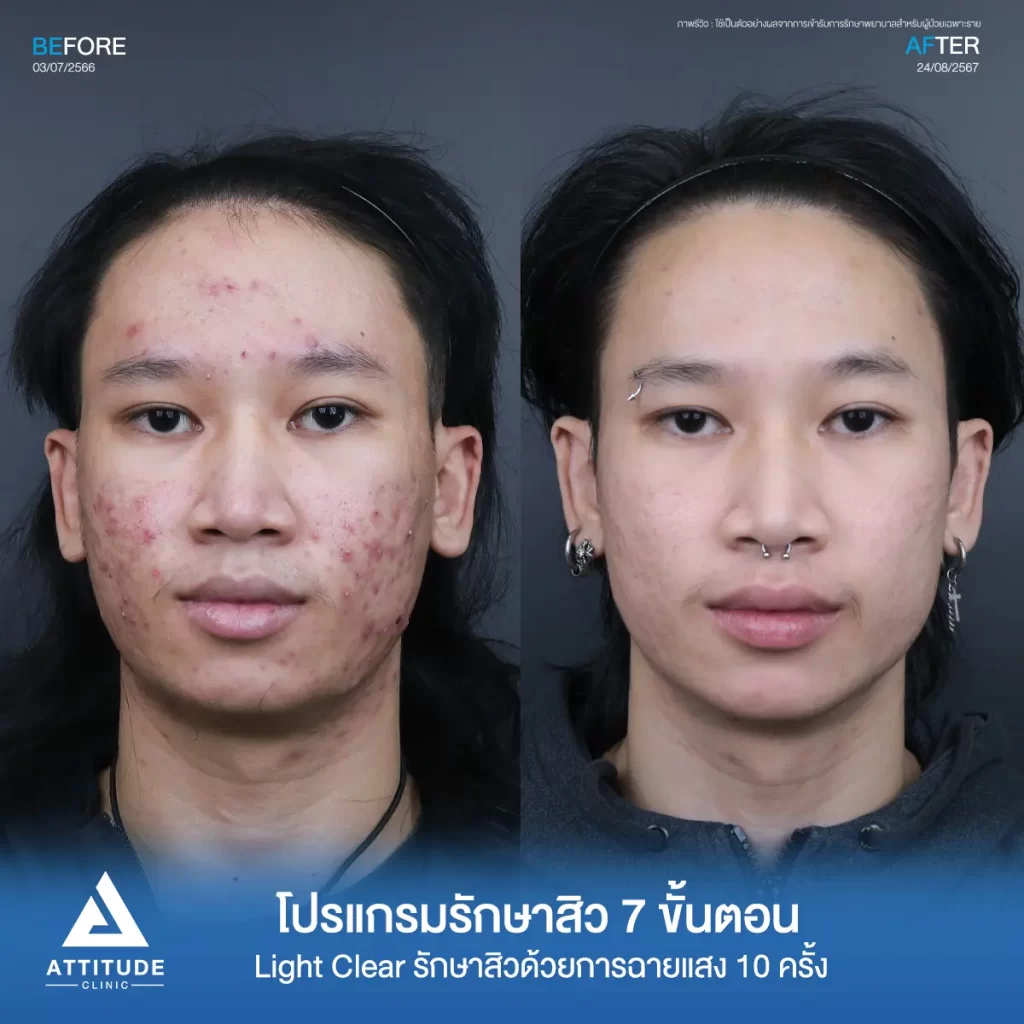 รีวิวรักษาสิวคุณบดินทร์ ด้วยการฉายแสง โปรแกรมรักษาสิว Light Clear 7 ขั้นตอน จำนวน 10 ครั้ง รักษาสิวอักเสบเม็ดใหญ่ สิวหนอง รอยแดงทั่วใบหน้าลามลงมาถึงต้นคอที่ Attitude Clinic