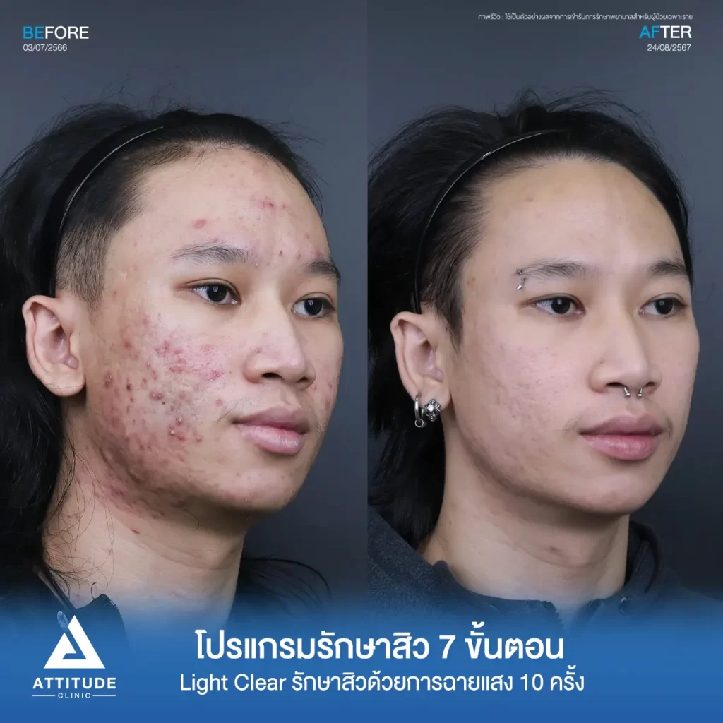 รีวิวรักษาสิวคุณบดินทร์ ด้วยการฉายแสง โปรแกรมรักษาสิว Light Clear 7 ขั้นตอน จำนวน 10 ครั้ง รักษาสิวอักเสบเม็ดใหญ่ สิวหนอง รอยแดงทั่วใบหน้าลามลงมาถึงต้นคอที่ Attitude Clinic