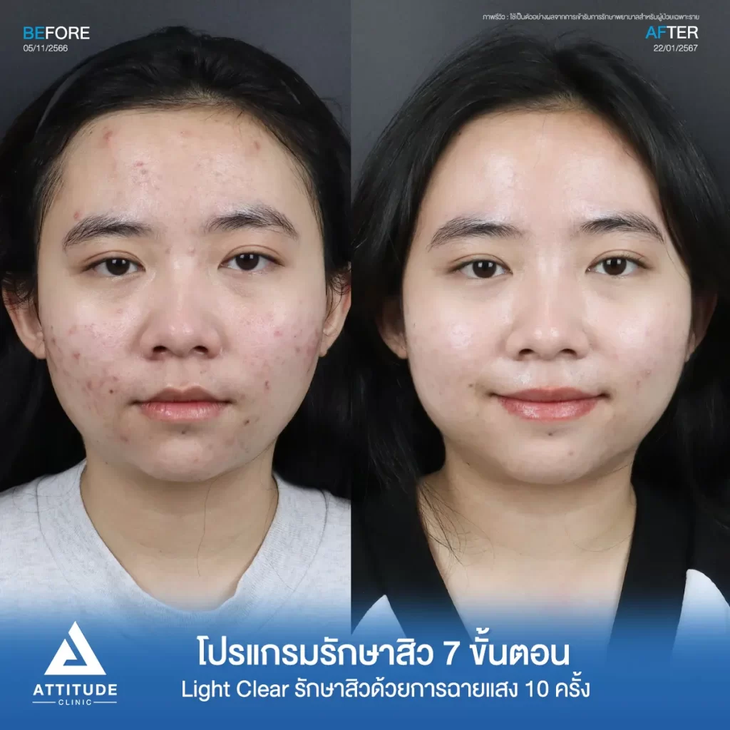 รีวิวรักษาสิวคุณไอซ์ ด้วยการฉายแสง โปรแกรมรักษาสิว Light Clear 7 ขั้นตอน จำนวน 10 ครั้ง รักษาสิวอักเสบ สิวอุดตัน และรอยแดงสิวทั่วใบหน้าที่ Attitude Clinic