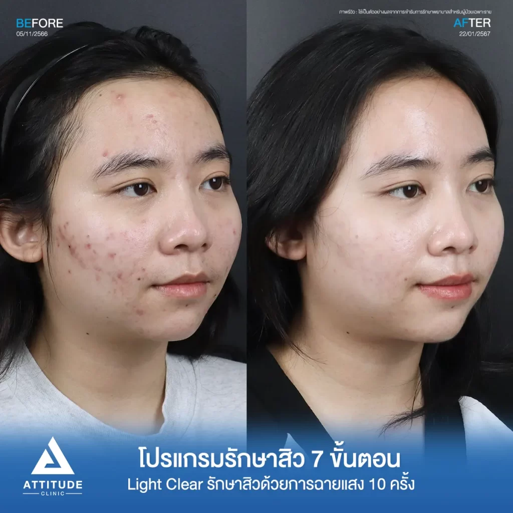 รีวิวรักษาสิวคุณไอซ์ ด้วยการฉายแสง โปรแกรมรักษาสิว Light Clear 7 ขั้นตอน จำนวน 10 ครั้ง รักษาสิวอักเสบ สิวอุดตัน และรอยแดงสิวทั่วใบหน้าที่ Attitude Clinic